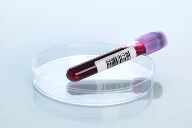 نمونه خون آزمایش خون