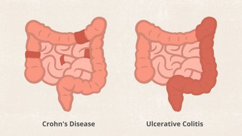 تفاوت بین بیماری کرون و کولیت اولسراتیو چیست؟