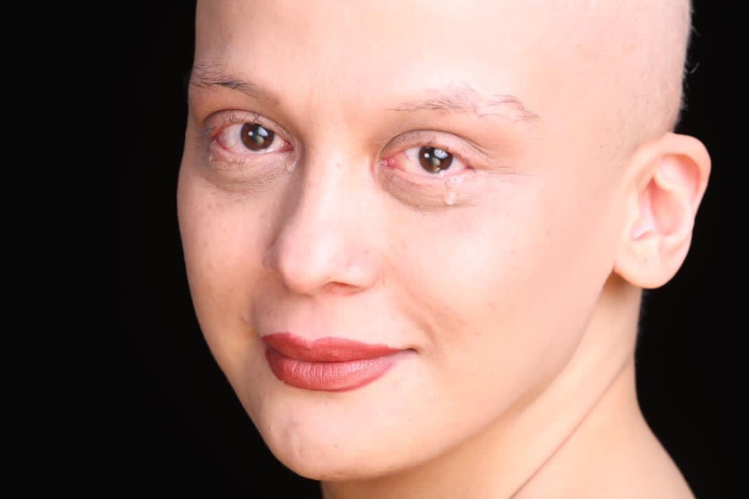 چهره غم‌انگیز مارال فرجاد بعد از شیمی‌درمانی